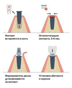 Медентис двухэтапная имплантация зубов