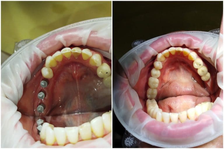 Медентис коронки керамические с опорой на имплантатах