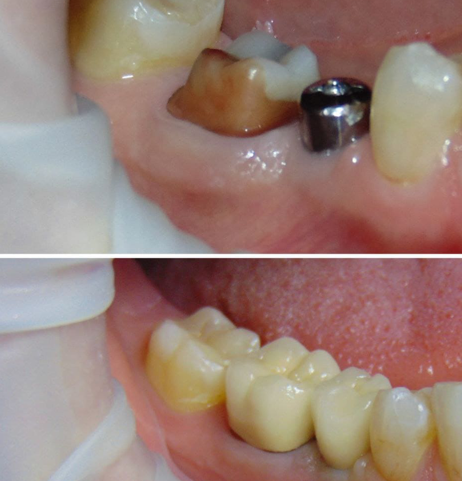 Медентис одномоментная имплантация