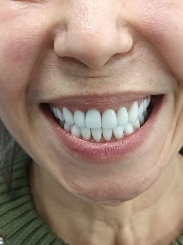 Медентис плюс имплантация зубов без боли