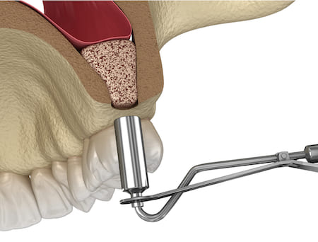 Медентис Синус-лифтинг