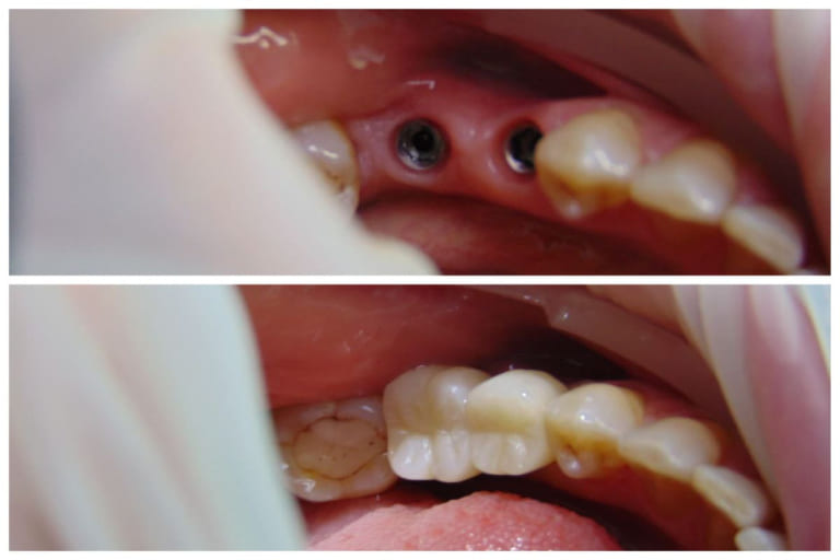Медентис установка двух имплантов