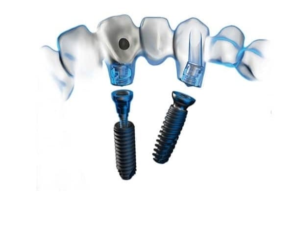 Медентис имплантация зубов имплантаты Антожир