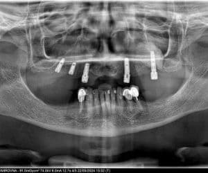 Медентис цифровая имплантация зубов